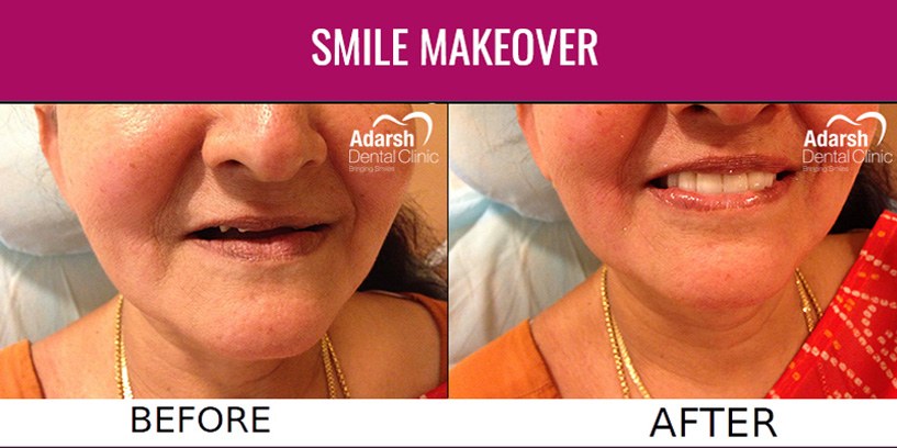 before and after smile makeover treatment