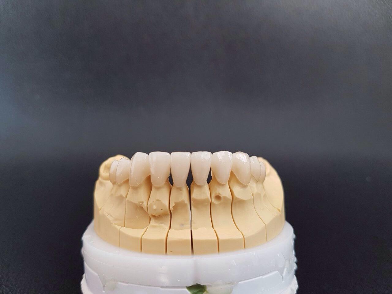 e-max-Dental-crowns