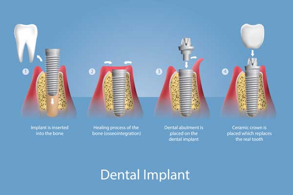 dental implant procedure in chennai, tamil nadu
