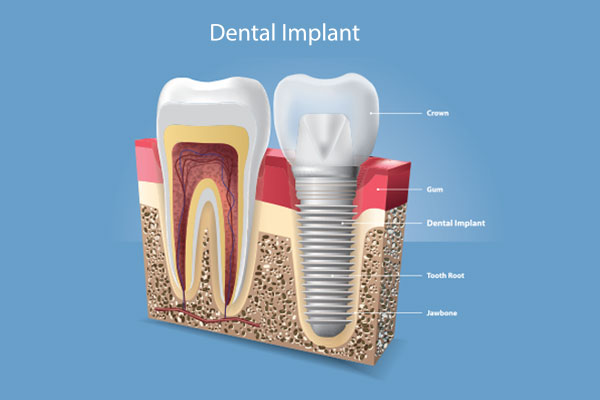 single tooth implants in chennai, tamil nadu, India