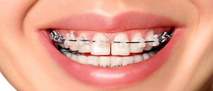 ceramic braces in chennai, tamil nadu, india