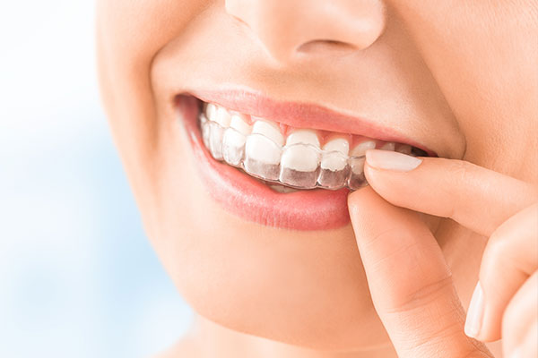 Invisalign Treatment Chennai Invisible Aligners Clear Aligners Tamil Nadu