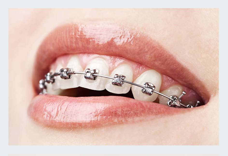 metal dental braces in chennai, tamil nadu, india