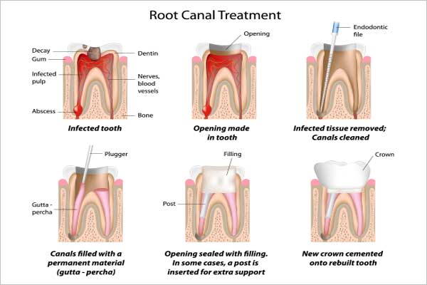 root canal procedure in chennai, tamil nadu
