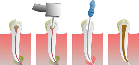 root canal treatment chennai, tamil nadu, india