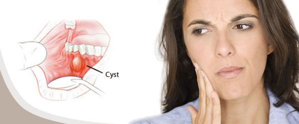 dental cysts